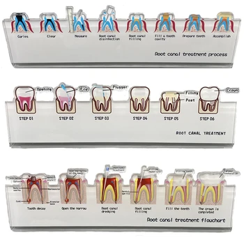 1gab Zobu Slimību-Sakņu Kanālu Ārstēšana Shēma Zobu Mācīšanas Modelis Endodontiskās Modeli, Zobārsts, Sakaru Mācību